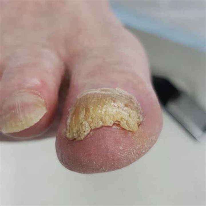 Why do diabetics have thick toenails?