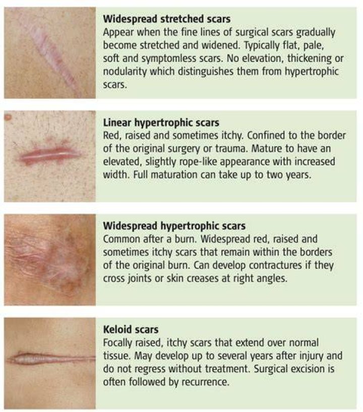Why do healed scars itch?