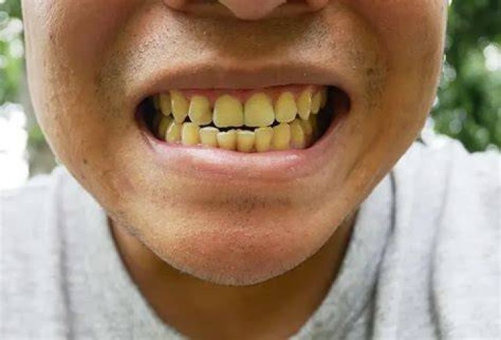 Why do redheads have yellow teeth?