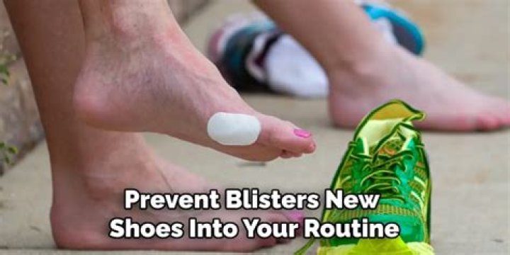 Why do shoes always give me blisters?