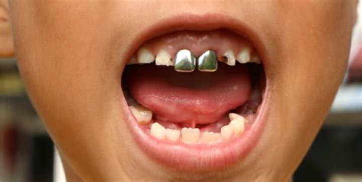 Why do you get silver teeth?
