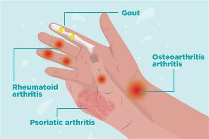 Why does arthritis hurt so much?