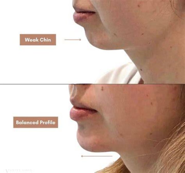 Why does my chin have pimples?