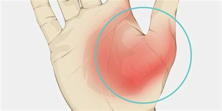 Why does my palm hurt by my thumb?
