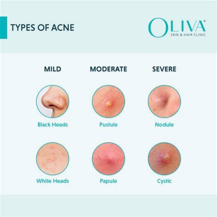Why is my acne getting worse all of a sudden?