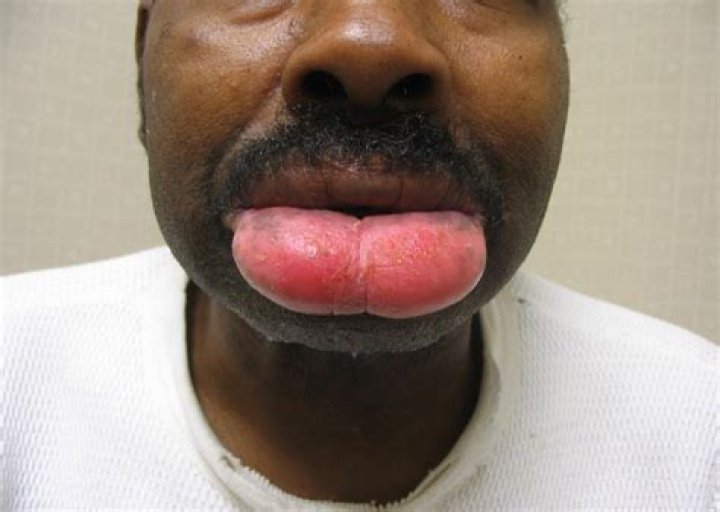 Why is my lip swollen for no reason on one side?