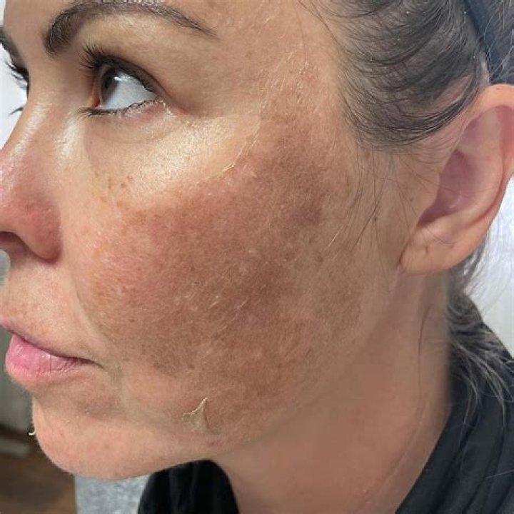 Why is my skin worse after a facial?