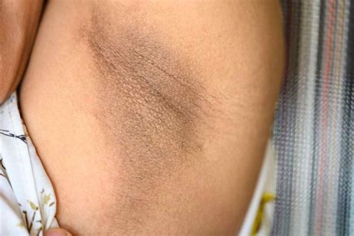 Why my armpits are black?