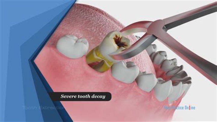 Will a dentist remove all my teeth?