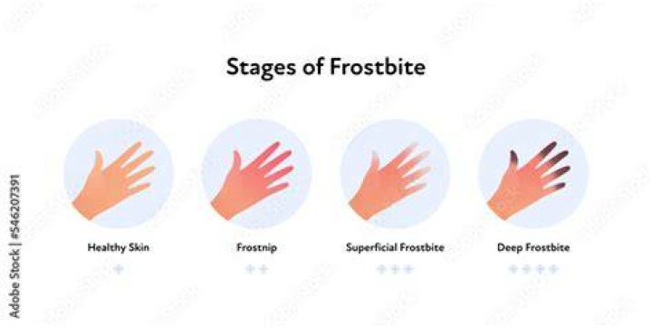 Will Frostnip go away?