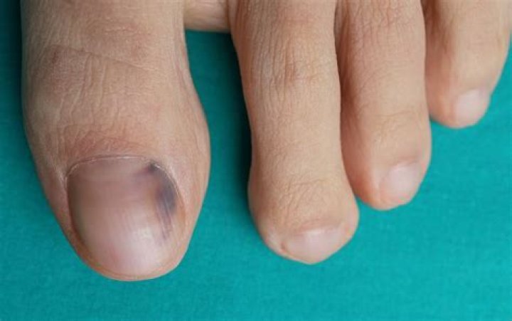 Will my nail fall off after smashing it?