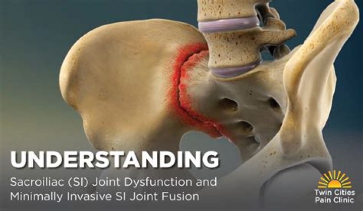 Will SI joint dysfunction show on an MRI?