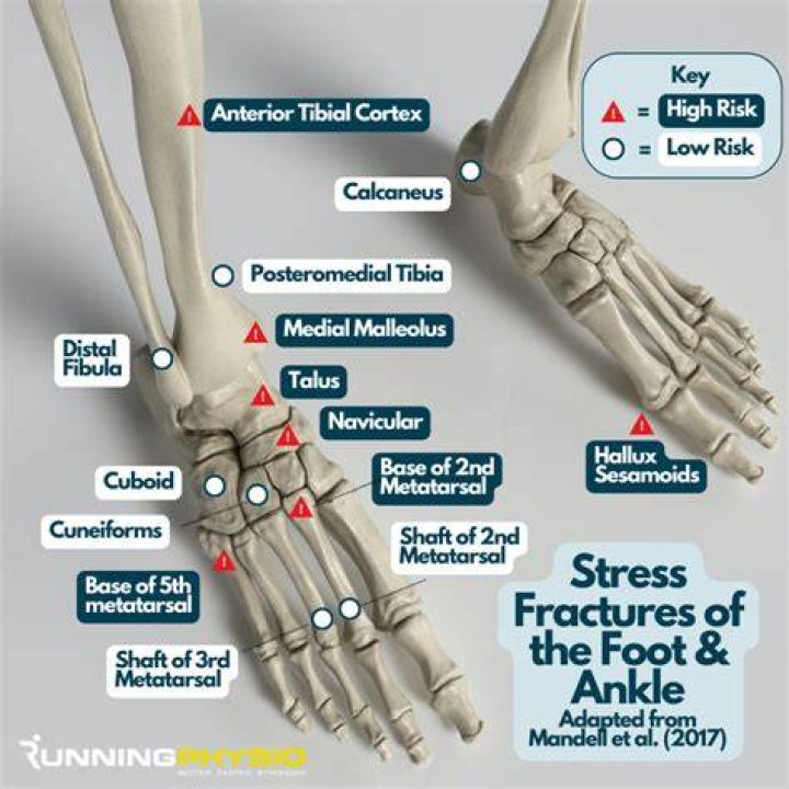 Will walking on a fractured foot make it worse?