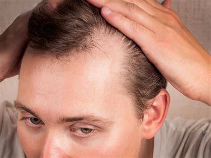 Will wearing a hard hat cause baldness?